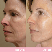 🔥LAST DAY SALE 49% OFF-🌸V-Face👑 Lifting Invisible Adhesive Tape