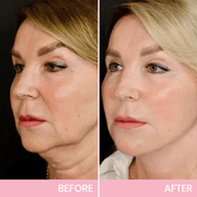 🔥LAST DAY SALE 49% OFF-🌸V-Face👑 Lifting Invisible Adhesive Tape